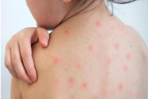 দেশে গত ২৪ ঘণ্টায় হামে আরও ২ জনের মৃত্যু: আক্রান্ত ছাড়ালো ১৭ হাজার